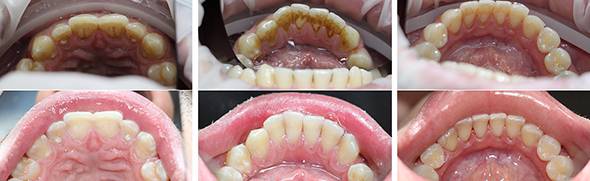 Фото последовательной очистки зубов от налета и зубного камня