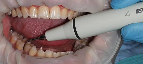 Плюсы и минусы удаления зубного камня ультразвуком