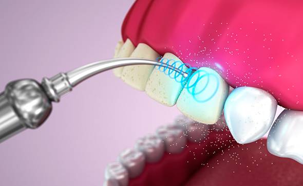Процедура удаления зубного камня с помощью ультразвука: цена услуги и отзывы клиентов