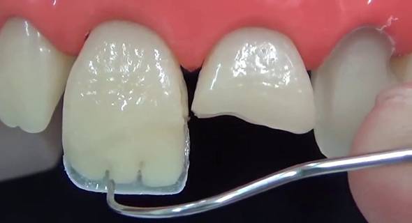 Прямая реставрация зуба